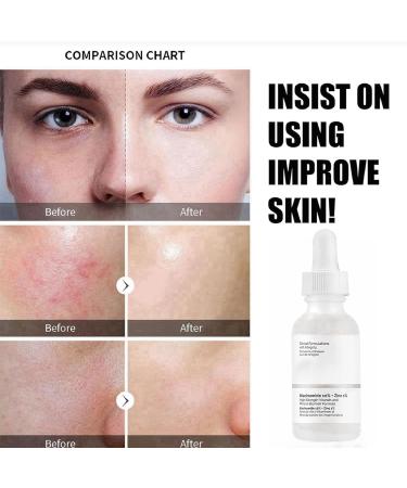 10% Niacinamide Serum+ 1% Zinc Serum Face Moisturizer High-Strength Vitamin Niacinamide Serum Face Serum for Women Minimises Pore Niacinamide Brightening Toner Hydrating Serum for Tackles Blemishes - Buy Online on GoSupps.com