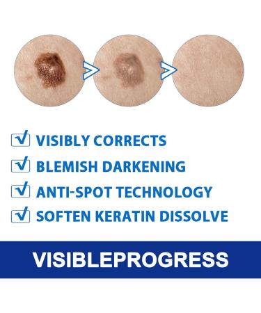 Maximum Strength Fast Acting Wart Cream with Salicylic Acid | Effective Wart Remover for Common Plantar & Genital Warts | International Shipping Available - Buy Online on GoSupps.com