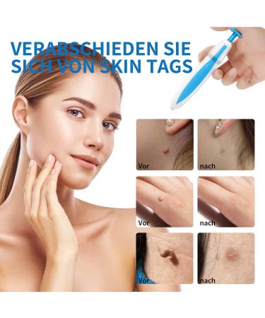 Fast & Safe Wart & Skin Tag Remover Kit | Painless 2-in-1 Solution for Micro to Large (2mm - 8mm) | International Shipping Available - Buy Online on GoSupps.com