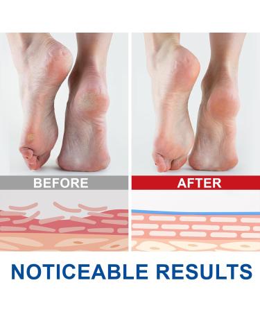 QLIGES Urea cream 60 urea cream 60 foot care stick deeply moisturizing and fast absorbing gentle exfoliation for dry cracked heel and thickened skin - Buy Online on GoSupps.com