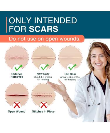 Silicone Scar Sheets 1.5 x 78 Roll - Reusable Medical Scar Tape for C-Section Keloid Stretch Marks & Surgical Scar Removal - Buy Online on GoSupps.com