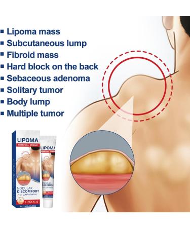 Cr me Naturelle D' limination des Lipomes Cr me D' limination des Lipomes V g taux Lipoma Elimination Cream Doux et Non Stimulant 1PC - Buy Online on GoSupps.com