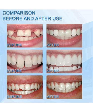 Temporary Tooth Filling Repair Kit - Moldable False Teeth Replacement | Tooth Repair Granules for Quick Fix | Fake Teeth Repair Beads - Buy Online on GoSupps.com