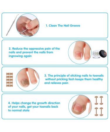 Jeffdad Ingrown Toenail Treatment Kit | Professional Removal & Correction | Lifter & Clipper Included | Quick & Effective Nail Repair - Buy Online on GoSupps.com