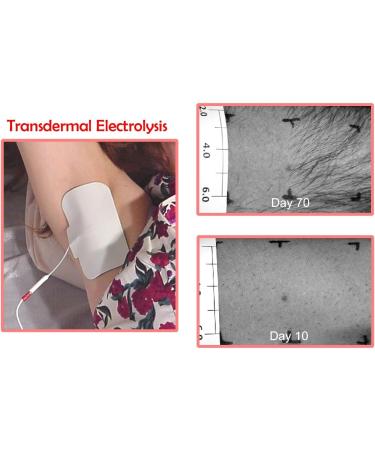 AVX400 Salon Quality Transdermal Electrolysis System - Permanent Hair Removal - Buy Online on GoSupps.com