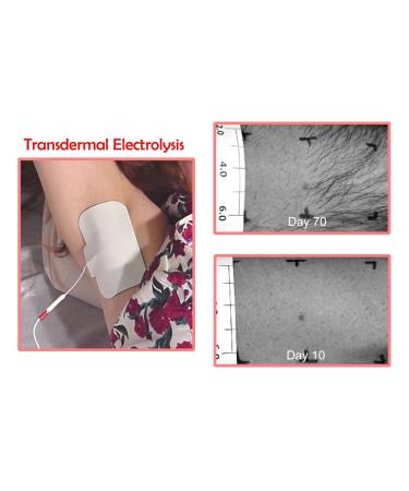 Aavexx 300 Transdermal Electrolysis System - Non Invasive & Highly Effective Home Hair Removal - Buy Online on GoSupps.com