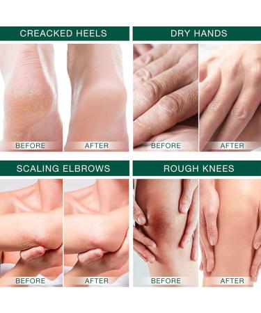 Urea Foot Cream 40% Urea Cream for Feet Foot Nourishing Cream for Cracked Heels and Dry Skin Deep Moisturizing - Buy Online on GoSupps.com