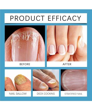 Nail Cleaning Device | Repair Fingernails & Toenails Nail Treatments Care Device - Versatile Professional Fingernails & Toenails Repair Device for Normal Abnormal Nails - Buy Online on GoSupps.com