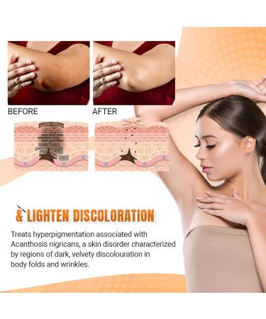 DILUTE Acantho Clear Therapy Spray - Acanthosis Nigricans Treatment for Dark Knuckles & Spots (2 PCS) - Buy Online on GoSupps.com