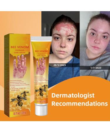 Hhkuize Bee Venom Psoriasis Treatment Cream - Natural Eczema Moisturizing Cream (6PCS) - Buy Online on GoSupps.com