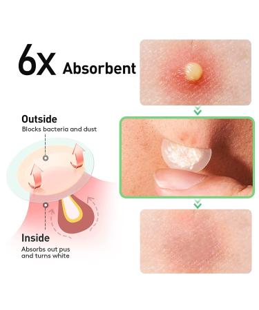 Zebran 300 Pcs Hydrocolloid Pimple Patches - Invisible 2-in-1 Acne Treatment Waterproof Day & Night Solution - Buy Online on GoSupps.com