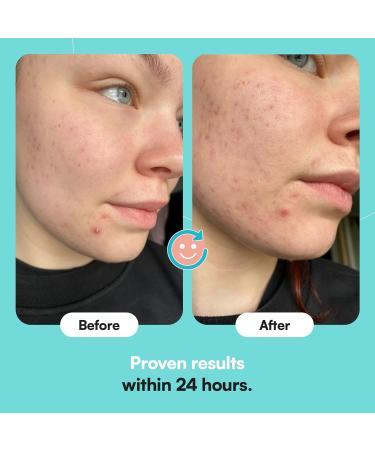 Skinchoice Breakout Pimple Plaster - 75 Hydrocolloid Acne Treatment Vegan & Cruelty-Free Powerful Pimple Relief (1 Pack) - Buy Online on GoSupps.com