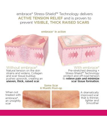 Embrace Active Scar Defense - FDA-Cleared Silicone Scar Sheets for New Scars | 60 Day Supply | Medium 2.4 Inch - Buy Online on GoSupps.com