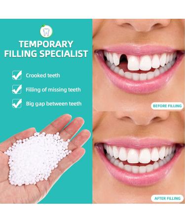 Tooth Repair Kit - Temporary Teeth Filling Replacement for Chipped Teeth with Thermal Beads - Ideal for Fixing Missing or Broken Teeth - Buy Online on GoSupps.com
