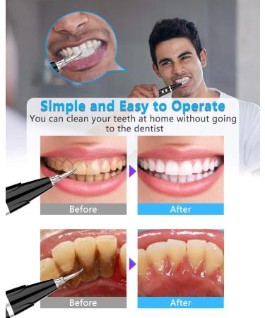 Ultrasonic Tooth Cleaner - Plaque Remover with LED, 5 Modes - Safe Dental Tool for Teeth Stain & Tartar Removal - Buy Online on GoSupps.com