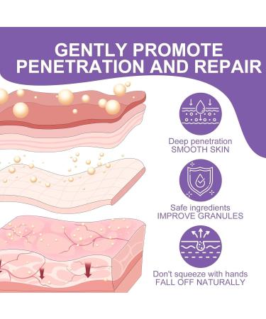 Milia Remover for Eyes and Face Milia Spot Treatment with Salicylic Acid Milia Acne Cream Scented - Buy Online on GoSupps.com