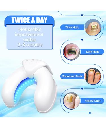 Buy Nail Fungus Laser Treatment Device - Rechargeable & Portable Cold Laser Therapy for Fingers & Toenails - Buy Online on GoSupps.com