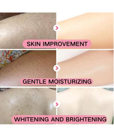 Keratosis Pilaris Improvement Body Cream - Body Moisturiser - Body Creams for Women - Firming Body Lotion for Soothing and Repairing - Dry Skin Moisturiser for Skincare - Nourishing & Moisturing - Buy Online on GoSupps.com