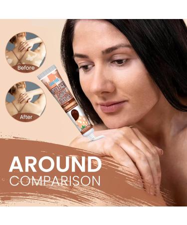 Vitiligo Care Ointment 20g | Repigmentation & Relief Cream | Improves Skin Pigmentation | Easy to Apply | 5-Pack - Buy Online on GoSupps.com