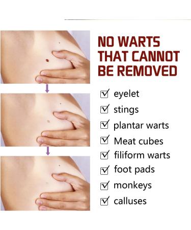 Stylo Anti Verrue Anti Taupe Stylo Pour Enlever Grain De Beaut Anti Cors Pieds Stylo Liquide D' limination Des Verrues Wart Removal Cream Cr me D' limination Instantan e des Verrues 2PC - Buy Online on GoSupps.com