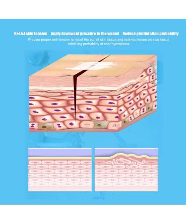 Raguso Zip Stitch Sutures: Noninvasive Skin Closure Device - Waterproof, Breathable, Adjustable - 2pcs for Painless Wound Care - Buy Online on GoSupps.com