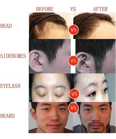 Hair Follicle Extractor Hair Transplant Treatment Growth System with 0-20000rpm Stepless Speed Regulation Safe Without Scars for Ease Helps Hair Loss Receding Hairline Thinning Hair - Buy Online on GoSupps.com