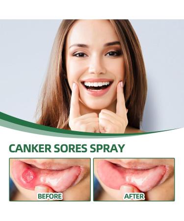 Mouth Bleeding Spray & Ulcer Treatment - Calming Mouth & Throat Spray (20ml) | Fast Relief for Mouth Wounds & Salivation - Buy Online on GoSupps.com