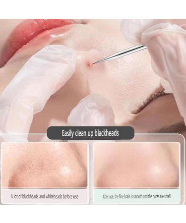 Cohbskj Usiveinborn Blackhead Remover Usiveinborn Tweezers Professional Blackhead Remover Tweezers Stainless Steel Facial Pimple Popper Tool for Women Men (Set F) - Buy Online on GoSupps.com