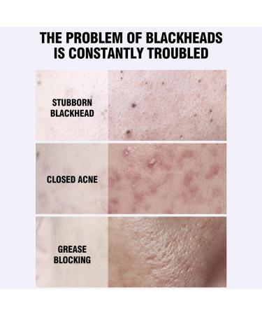 Blackhead Removal Strip105oz Pore Cleaner Strips Plant Purifying Clay Stick Moisturizing & Oil Control Facial Pore Cleanser for Women and Men Homraa - Buy Online on GoSupps.com