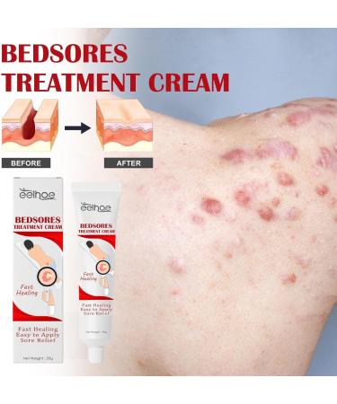 Pressure Soress Relief Cream 20g Bedsore Ointment Bed Soress Care Cream Fast Healing Soress Relief Healing Cream For Chafed Skin Hard-to-Heal Skin Soress Soothing Relief - Buy Online on GoSupps.com