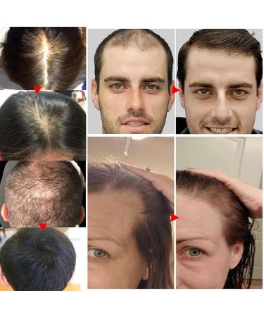 Ginger Oil & Biotin Hair Growth Serum - 100% Natural Treatment for Hair Loss Regrowth - Stronger, Thicker, Longer Hair - 1.0 Fl Oz (2 PCS) - Buy Online on GoSupps.com