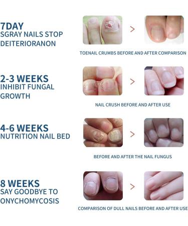 32 Pieces Toe Nail Repair Patch Soft Nail Inlay Gray Nail Care Toe Nail Thickening Clear Nail Groove Repair Patch - Buy Online on GoSupps.com