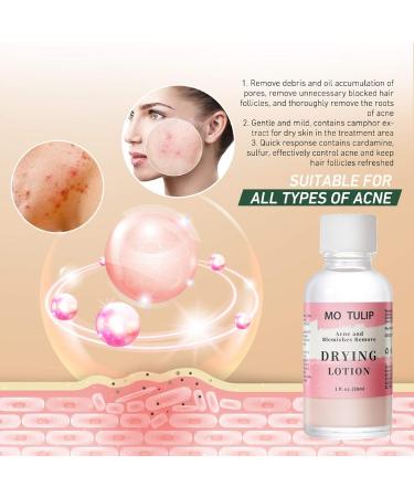 Acne Drying Lotion | Overnight Acne Treatment for Pimples & Blemishes | Fast Spot Treatment (1OZ) - International Shipping - Buy Online on GoSupps.com