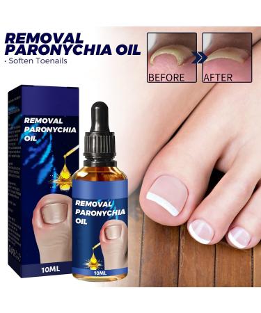 German Toenailcare Removal Oil | Paronychia & Ingrown Toenail Repair | Anti-Paronychia Relief Liquid for Nail Renewal - Buy Online on GoSupps.com