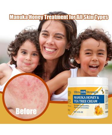 Manuka Eczema Eczema Cream Hand Foot Psoriasis Cream for Atopic Eczema Heat Rash Hidradenitis Itching Eczema Psoriasis Leg Armpit Foot Hand Irritated Skin for All Ages 4 Fl Oz (Pack of 1) - Buy Online on GoSupps.com