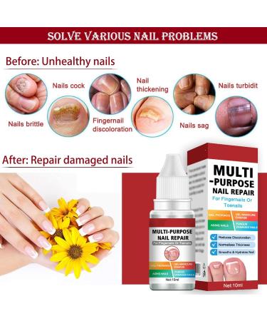 Fungal Nail Treatment for Toenail Extra Strong Multi-purpose Nail Repair Lotion for Fingernails Toenails Toe Nail Fungal Treatment Fixes Discolored Nails Safe Effective(10ML Red) - Buy Online on GoSupps.com