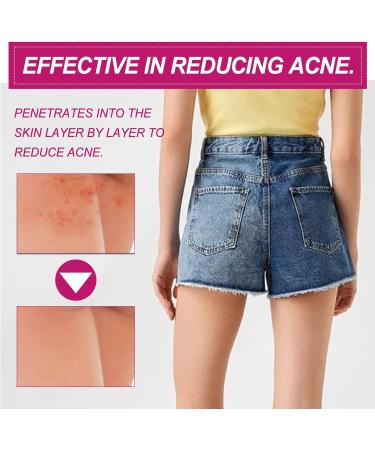 Butt Acne Treatment Butt Pimple Clearing Treatment Cream Butt Acne Treatment Balance Oil Butt Pimple Removing Cream Butt Acne Cream Reduce Acne and Pimple 100ml Butt Acne Treatment - Buy Online on GoSupps.com