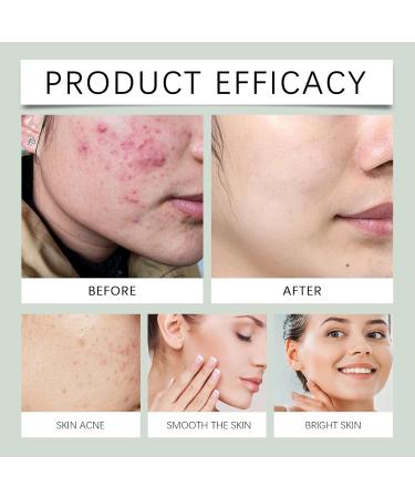 Acne Treatment Serum - Hydrating Oil-Control Formula Fades Acne Marks Brightens & Smoothes Skin Gentle Facial Care(2PCS) - Buy Online on GoSupps.com