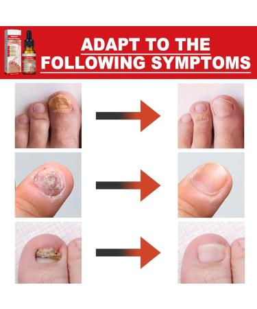 Ingrown Toenail Treatment Nail Growth Ingrowing Toenail Treatment Nail Helper Fungal Nail Treatment Correction Oil Drops Ingrown Toenail Corrector Toe Nail Fungus Treatment Cuticle Oil - Buy Online on GoSupps.com