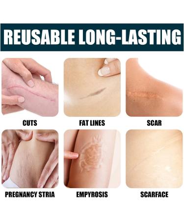 YoNGBAO Scar Removal Cream: Natural Extract, Brightens Skin, Improves Surgical Scars - Buy Online on GoSupps.com