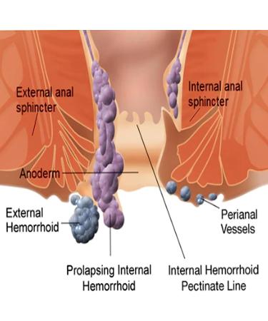 Heca Natural Herbal Hemorrhoid Capsules - Rapid Relief Suppository for Hemorrhoids (1pcs) - Buy Online on GoSupps.com
