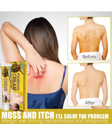 G-SHOTOY Revitaskin Eczema Cure Cream - Relief and Treatment for Adults with Psoriasis - Healthy Skin Treatment (2pcs) - Buy Online on GoSupps.com