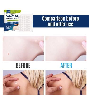 Skin Tag Remover Patch 144 PCS | Safe & Effective Skin Tag Removal Patches | 144 pcs/box - Buy Online on GoSupps.com