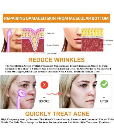 Twowin High Frequency Device for Acne Treatment & Skin Tightening | 60 Pcs Mull Masks Included - Shop Internationally! - Buy Online on GoSupps.com