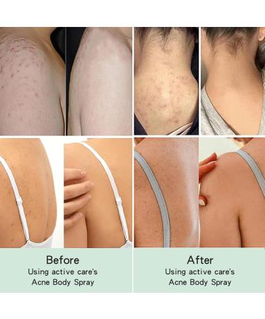 Acne Treatment Spray Lighten Acne Marks Skin Care Spray Herbaluxy Back Acne Treatment Body Moisturiser For Dry Skin Repair Back Shoulder Acne & Body Acne & Chest Acne & Butt Acne Gentle - Buy Online on GoSupps.com