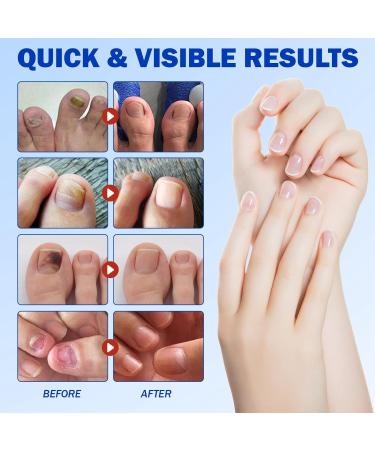 21 Patches Multi-Purpose Toenail Repair Treatment Pads Fungal Nail Patches Fungal Nail Treatment for Toenails Nail Repair for Damaged Nails Ingrown Toenail Treatment Fungal Nail Treatment Extra Strong - Buy Online on GoSupps.com