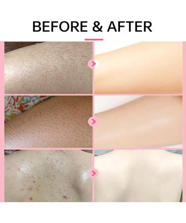 Keratosis Pilaris Lotion Leg Keratosis Pilaris Treatment Body Cream Skin Exfoliating Repair Cream Chicken Skin Care Cream Exfoliating Skin Body Lotion for Reduce and Smoothen Rough & Red Bump - Buy Online on GoSupps.com