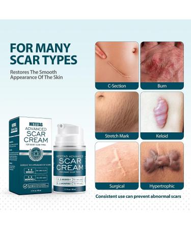 Metetas Advanced Scar Cream 1.7 Oz - Silicone Scar Gel for Surgical, C-Section, Stretch Marks, Keloids & Burns - Effective Treatment for Old & New Scars - 50ml - Buy Online on GoSupps.com