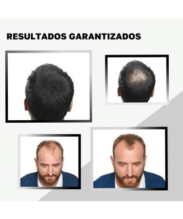 VIDALFORCE Premium Hair Densification I 100 Natural Ingredients I hair powder for full hair in seconds helps cover light hair protects against bald spots Light Brown Pack 2 x 30g - Buy Online on GoSupps.com