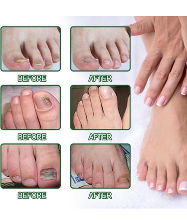 VKaoess Nail care pen with strengthening essence Cuticle support and renewal of the appearance of the nail for beautiful natural from plant serum for new nail maintenance 5 pieces - Buy Online on GoSupps.com